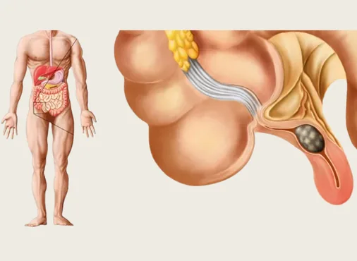 Appendix Disorders